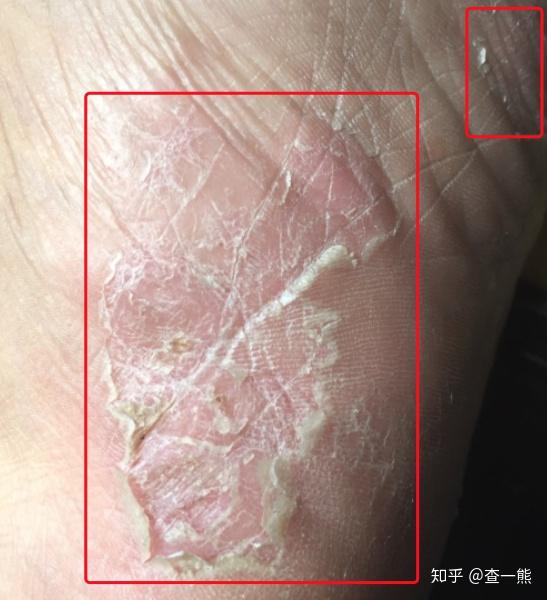 【皲裂型】:当寄生真菌侵蚀皮肤组织达到一定阶段,脚皮肤裂口较深