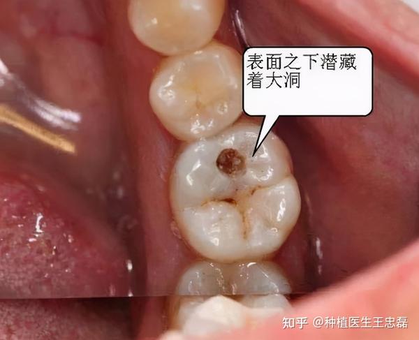 这里要提醒一下大家, 当你的牙齿被细菌腐蚀,出现牙洞,就该补牙啦!