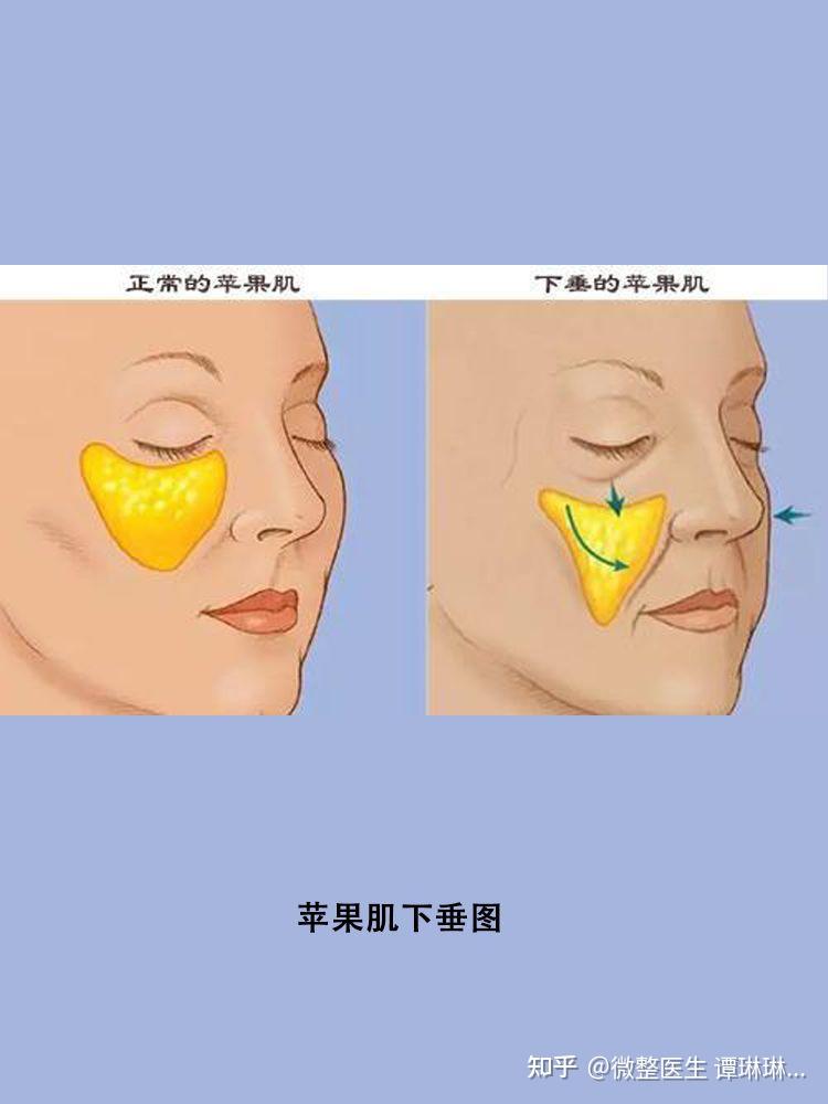 苹果肌下垂怎么办