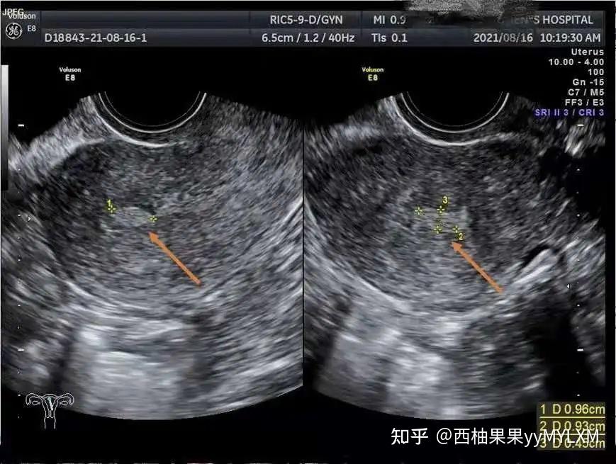 做试管遇见"子宫内膜息肉",切还是不切?会影响成功率吗?