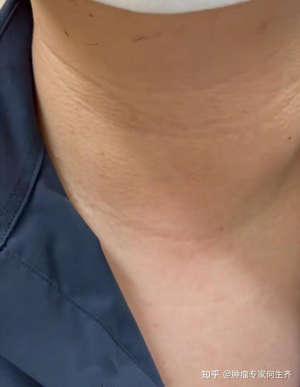 44岁男子甲状腺结节观察5年从18厘米长到5厘米结节增长过快怎么办