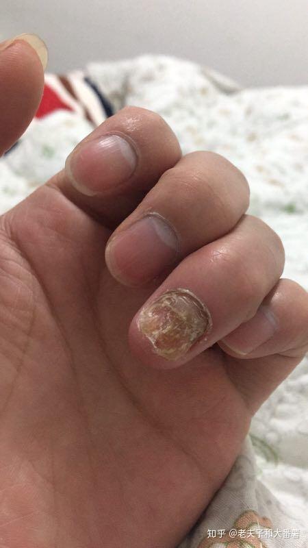 灰指甲会自己好吗