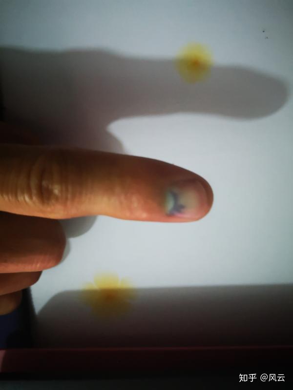 12中午,右手手指食指被砸了一下,指甲下出现瘀血,手指肿胀,疼痛.