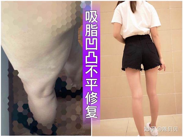 腿部做完吸脂后凹凸不平整怎么修复