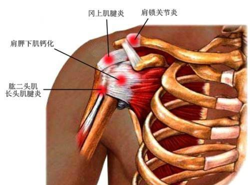 肩周炎,如何才能打开"粘连"?