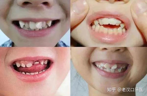 小孩子换牙期间牙齿不整齐需要矫正吗