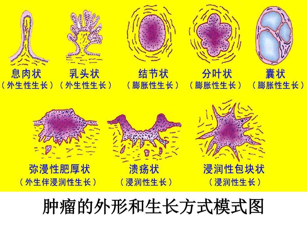 肿瘤小知识1肿瘤的形状颜色和硬度