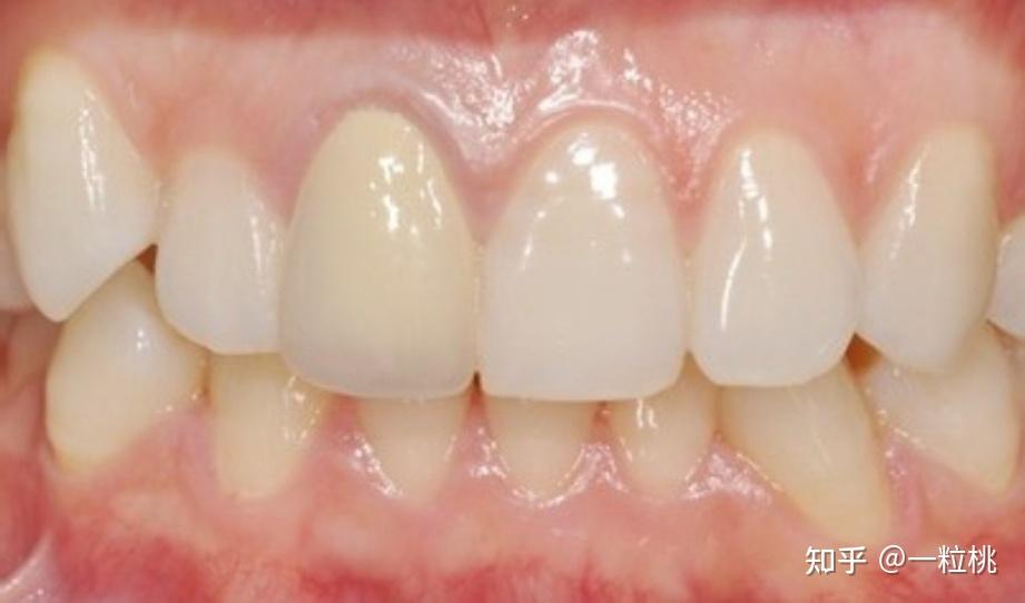 牙齿的结构就是这样了,牙齿的颜色是牙釉质和牙本质两种共同决定的.