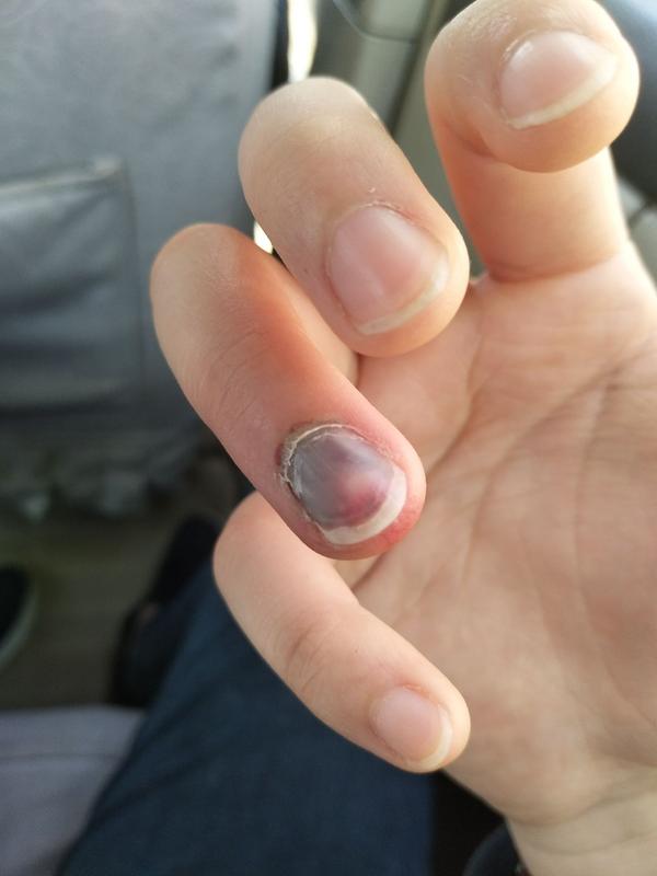 手指被门夹到飙泪是种怎样的体验?