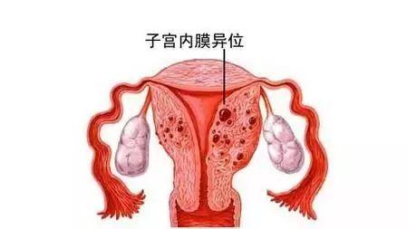 为何80%子宫内膜异位症女性,选择试管婴儿?