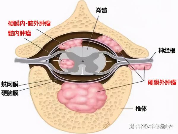 神经鞘瘤和脊膜瘤是较为常见的椎管内肿瘤,主要位于髓外硬膜下.