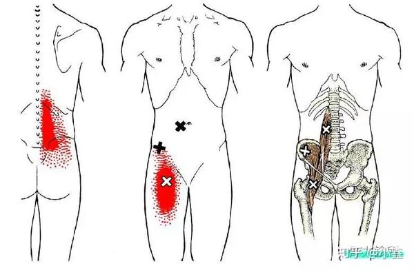 大腿根内侧痛髂腰肌综合征