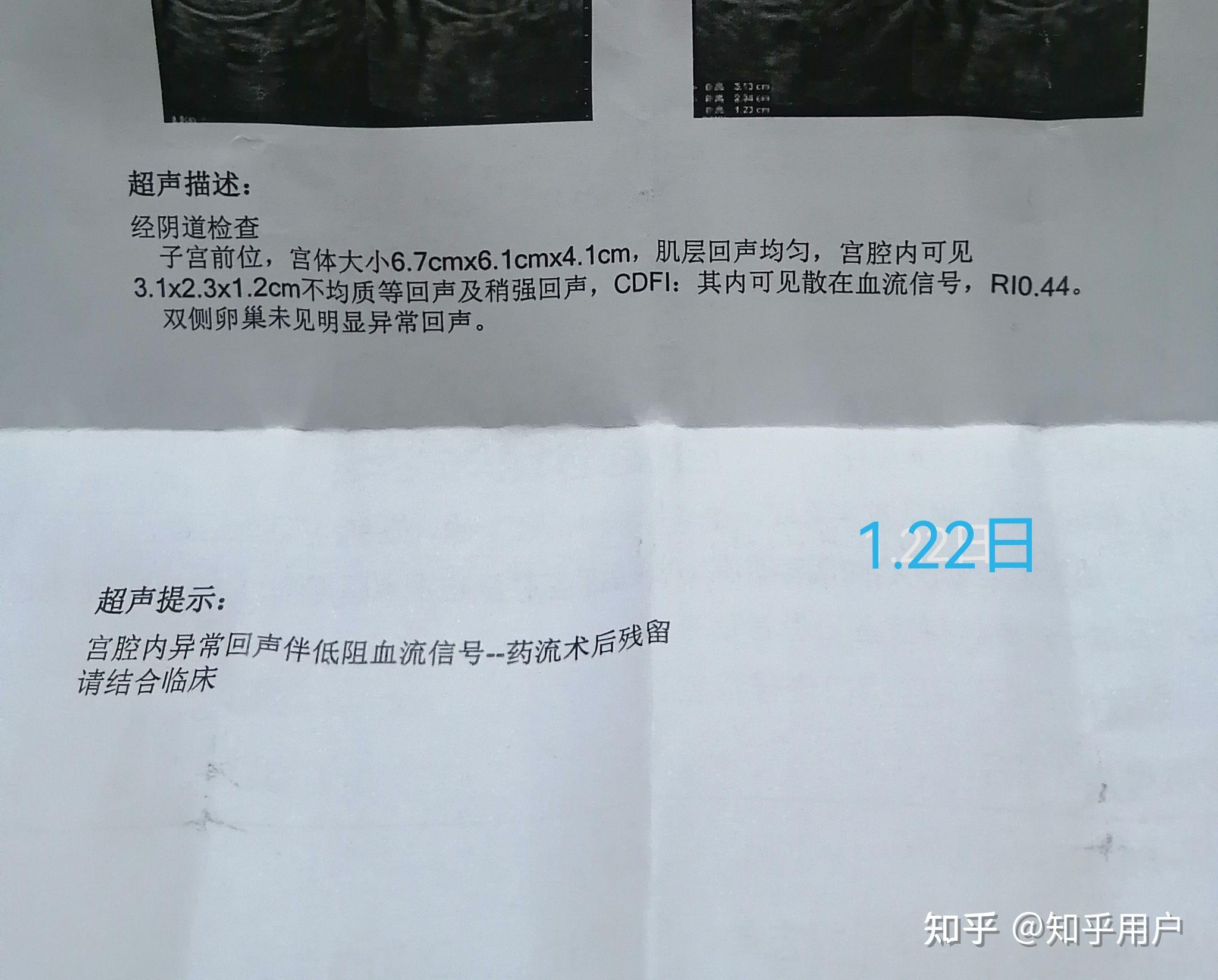 21 条评论默认时间代表月亮消灭你16天复查,4厘米残留,hcg273,医生让