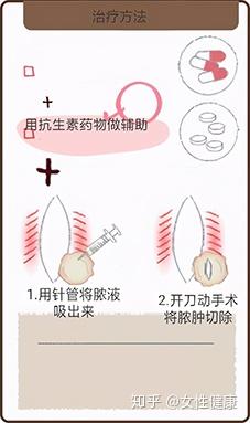 前庭大腺囊肿——女性门栓上的妇科病,常常被忽略