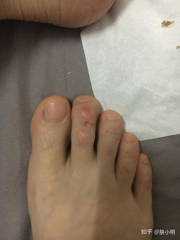 脚上被鞋子磨出茧要怎么办?