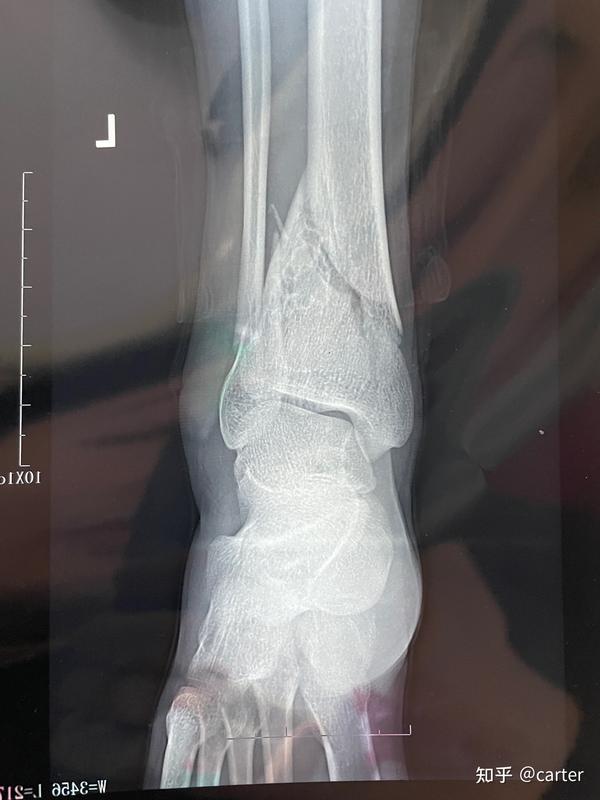 左胫骨腓骨远端骨折及pillon骨折康复记录(有手术刀口