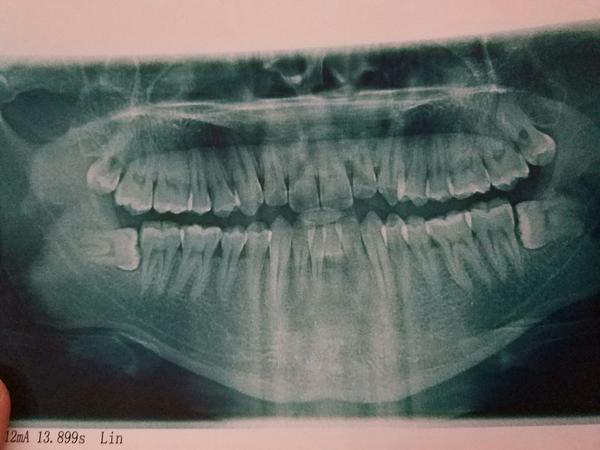 智齿横着长是一种怎样的体验?