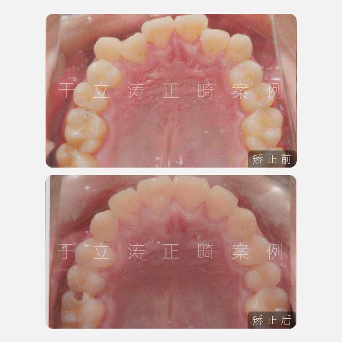 除了遗传因素导致的牙齿不齐外,还存在有牙周病,出现