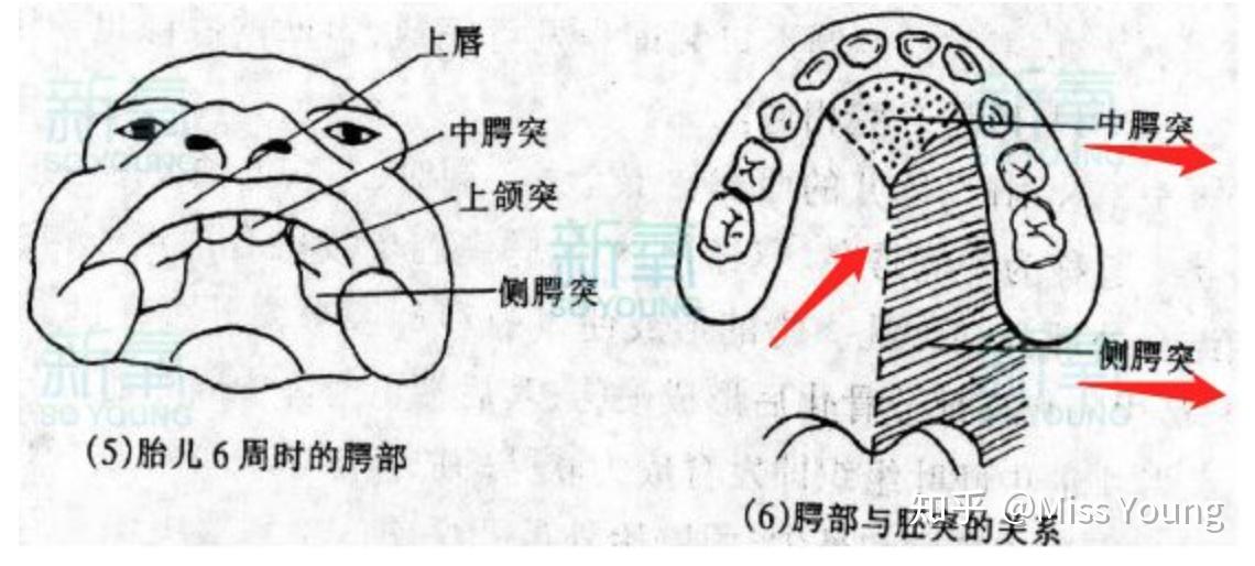 两边侧腭突之间,以及侧腭突和中腭突之间没有融合或者部分融合,就会