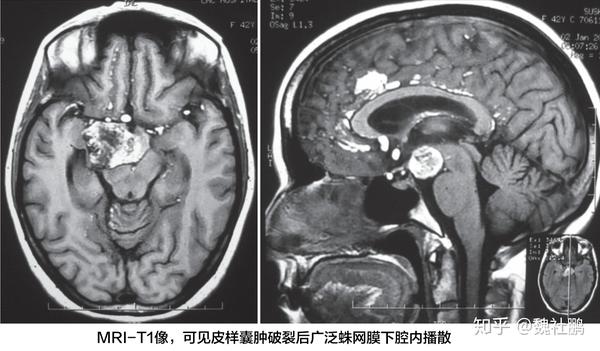 颅内表皮样囊肿和皮样囊肿