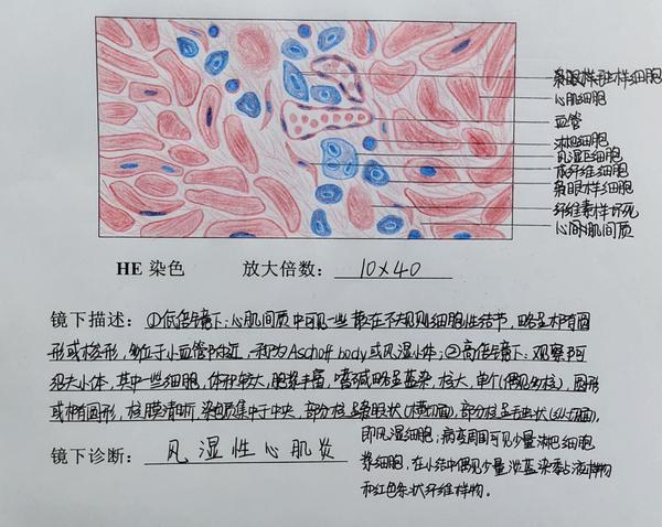 风湿性心肌炎绘图(阿绍夫细胞有两种:毛虫样和鹰眼样,绘图时阿绍夫