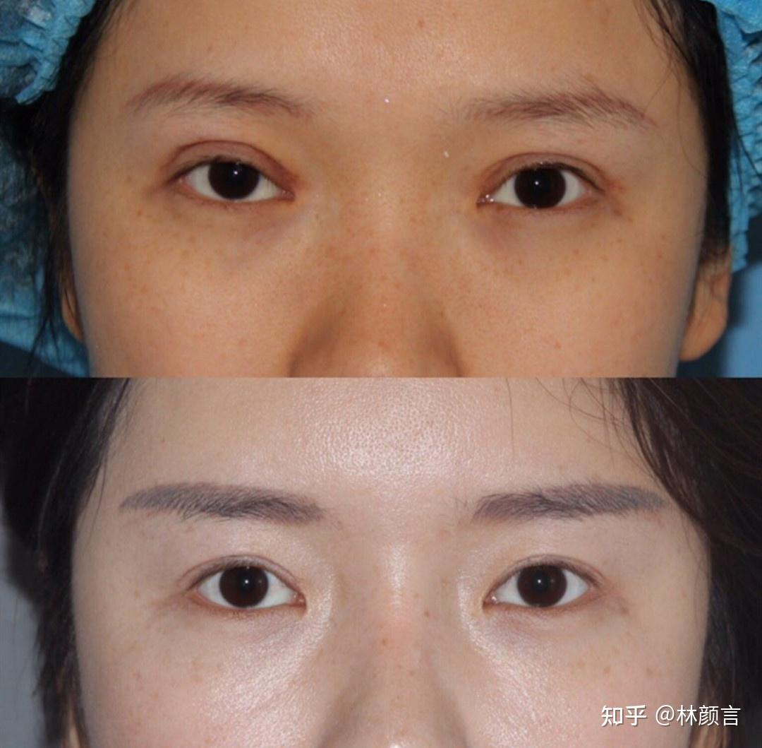 国内顶尖双眼皮修复医生有哪些附北京上海广州成都案例分析