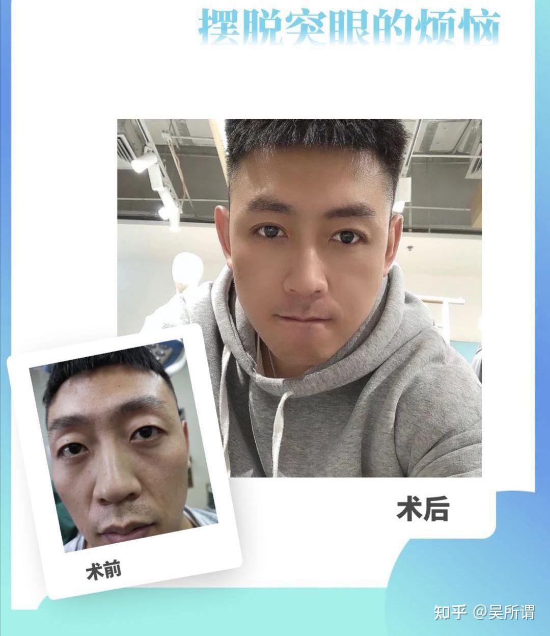 甲亢眼突恢复