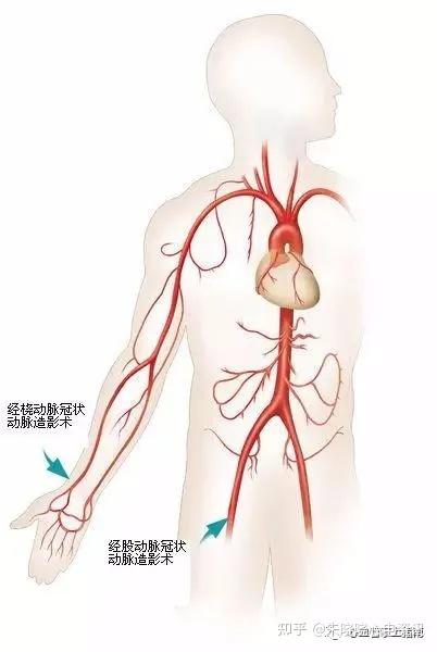 延行到心脏的冠状动脉开口处,然后把造影剂(在x光下显影)注入冠状动脉