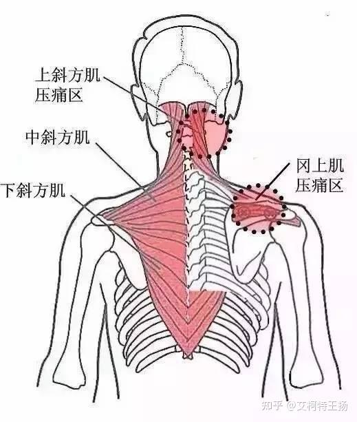 肩颈酸痛是什么原因?(天津艾柯特运动康复)