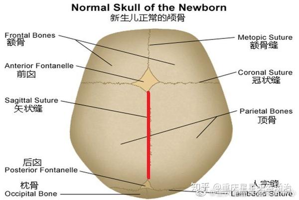 【颅缝早闭之失状缝早闭】