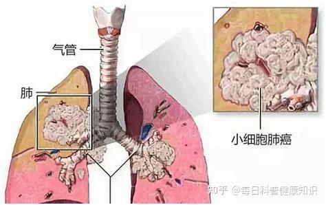 肺癌的表现:不明原因的干咳,痰中带血丝,常有固定性胸痛,发热, 其他