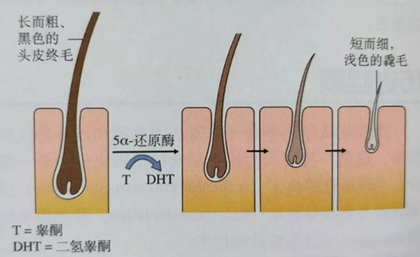 这个时候就需要赶紧采取补救措施,以免头发越来越细软,最后毛囊闭合