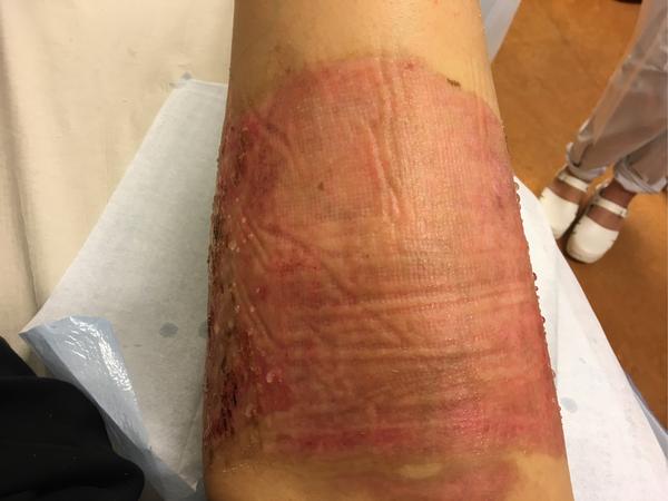 26天,基本都干了,所以护士没有用mepitel 了 总的来说烫伤时掉皮的
