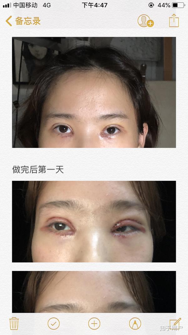全切双眼皮,多久消肿?有图.