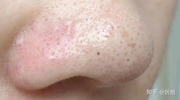 这是痘痘最早期的症状,分为开口粉刺和闭口粉刺.