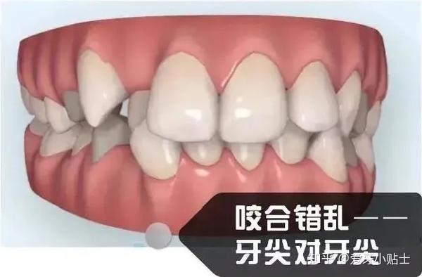 比如这样  牙齿最重要的功能就是咀嚼食物,牙齿咬合不对的人,上下牙齿