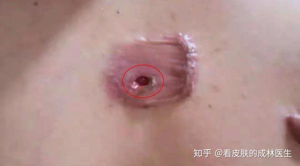 皮脂腺囊肿是疤痕疙瘩在发病过程中常会并发的另一种病症.