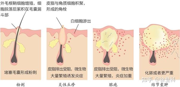 全网关于痘痘最全的科普看后不用别人教你怎么做你就是专家