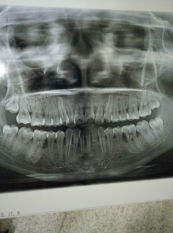 所以就去照了口腔侧位和全景(费用180),我的牙齿巨丑,但是男盆友还说