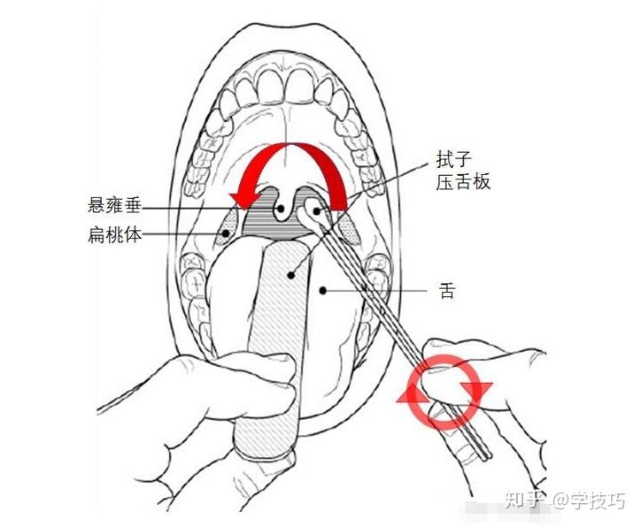 鼻拭子采样示意图:咽拭子采样示意图:无论是鼻咽拭子还是口咽拭子