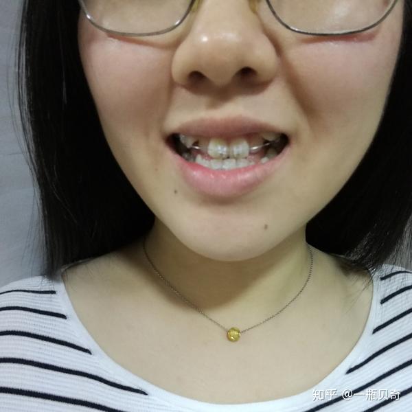 25 岁后去矫正牙齿(带牙套)是什么体验?