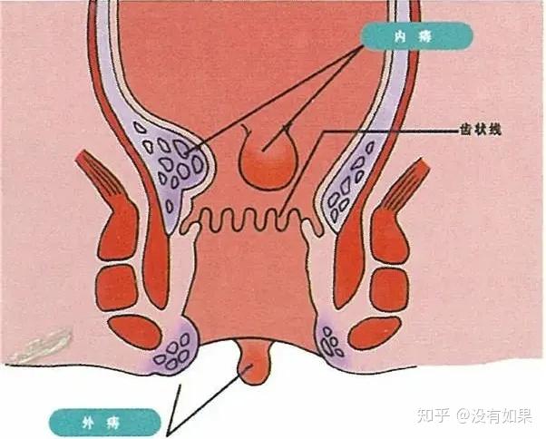 外痔:在齿状线以下为外痔,外痔可分为结缔组织性外痔,静脉曲张性外痔