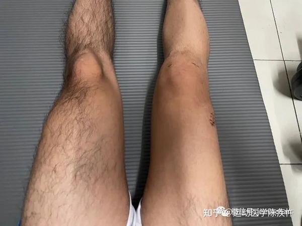 患者来信|前交叉韧带断裂后,我装了根人工韧带,6个月后拿到了mvp