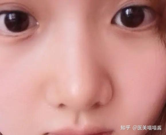 在成都做鼻子隆鼻算是我二十多年来做过很正确的决定了