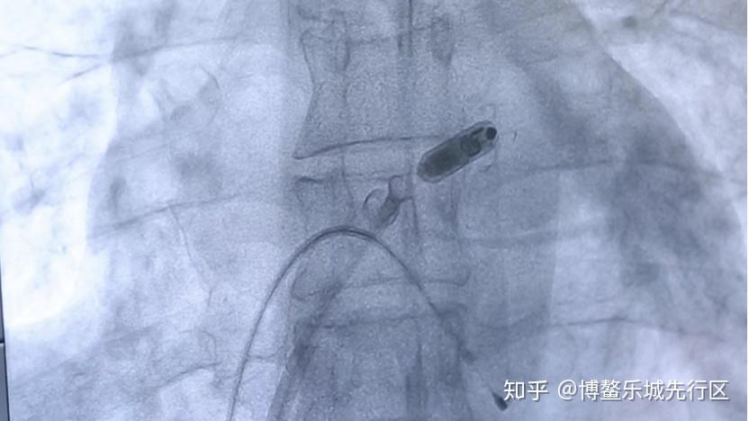 全球首个无导线双腔起搏器仅有胶囊大小重175克寿命可以达128年