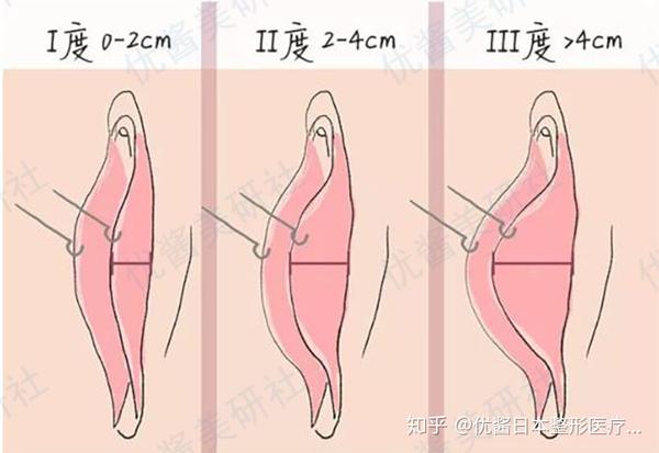 可能引发尿急,尿痛;若遮挡阴道口导致阴道分泌物不易排出,可能引发