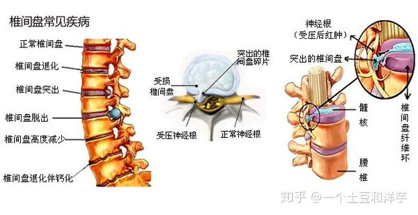 腰间盘突出在办公室怎么午睡 腰间盘突出在互相保范围内吗