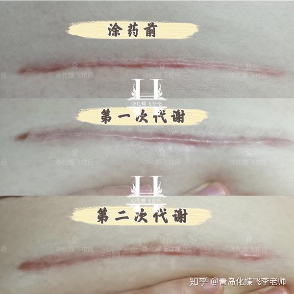 剖腹产疤痕增生变化过程