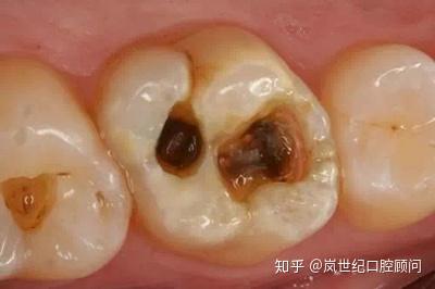 乳牙龋齿会影响恒牙吗