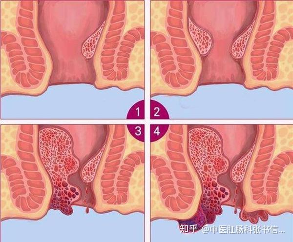 痔疮分4级,对号入座,看看你是哪一级?